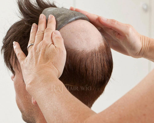 Hair Patch Delhi